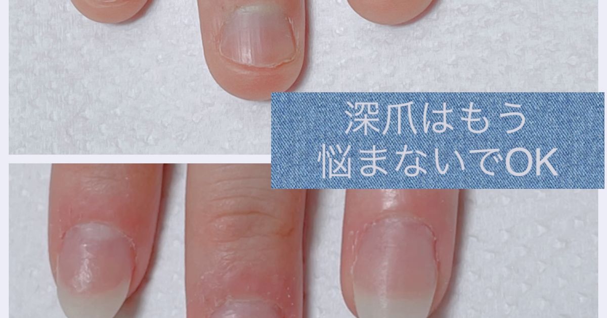 深爪矯正 美爪ケア
