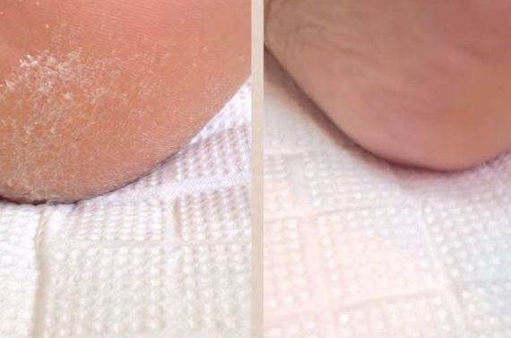 角質除去コース