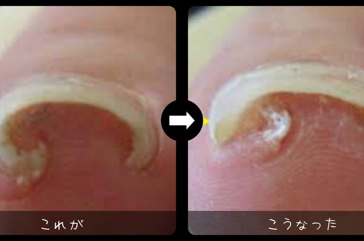 巻き爪